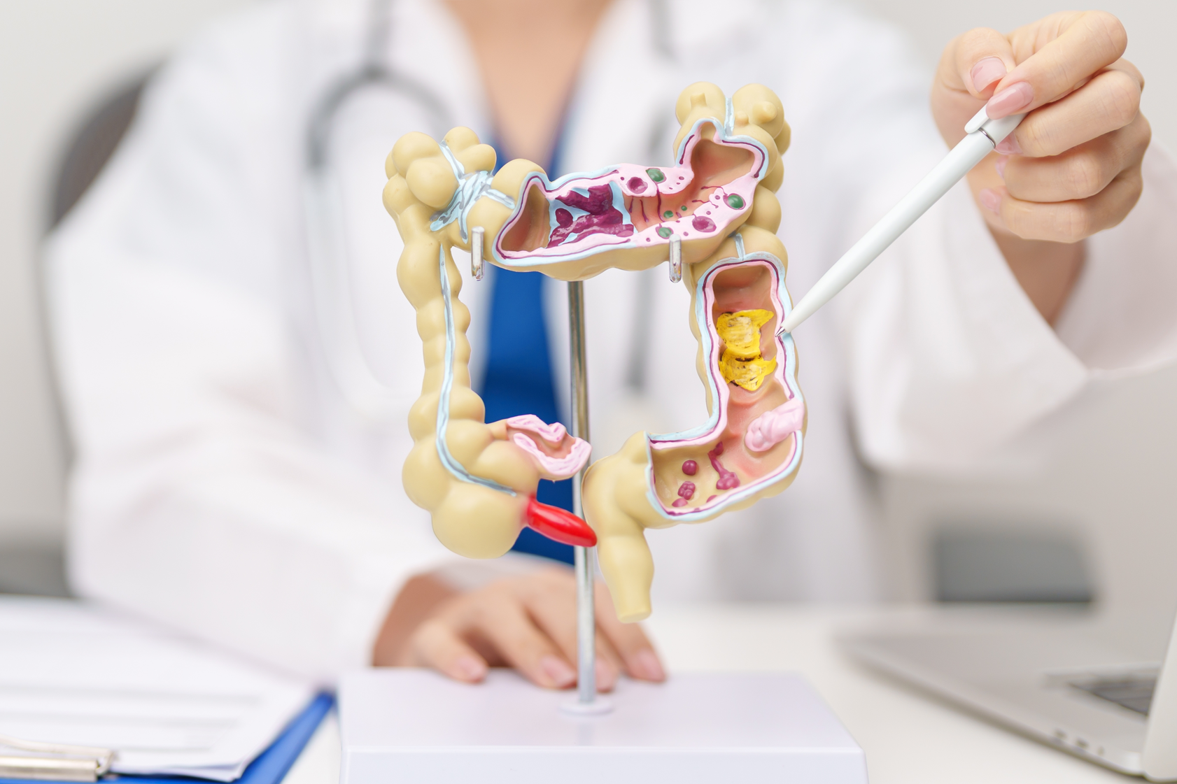 Doctor explaining colon cancer treatment using a human digestive anatomy model.