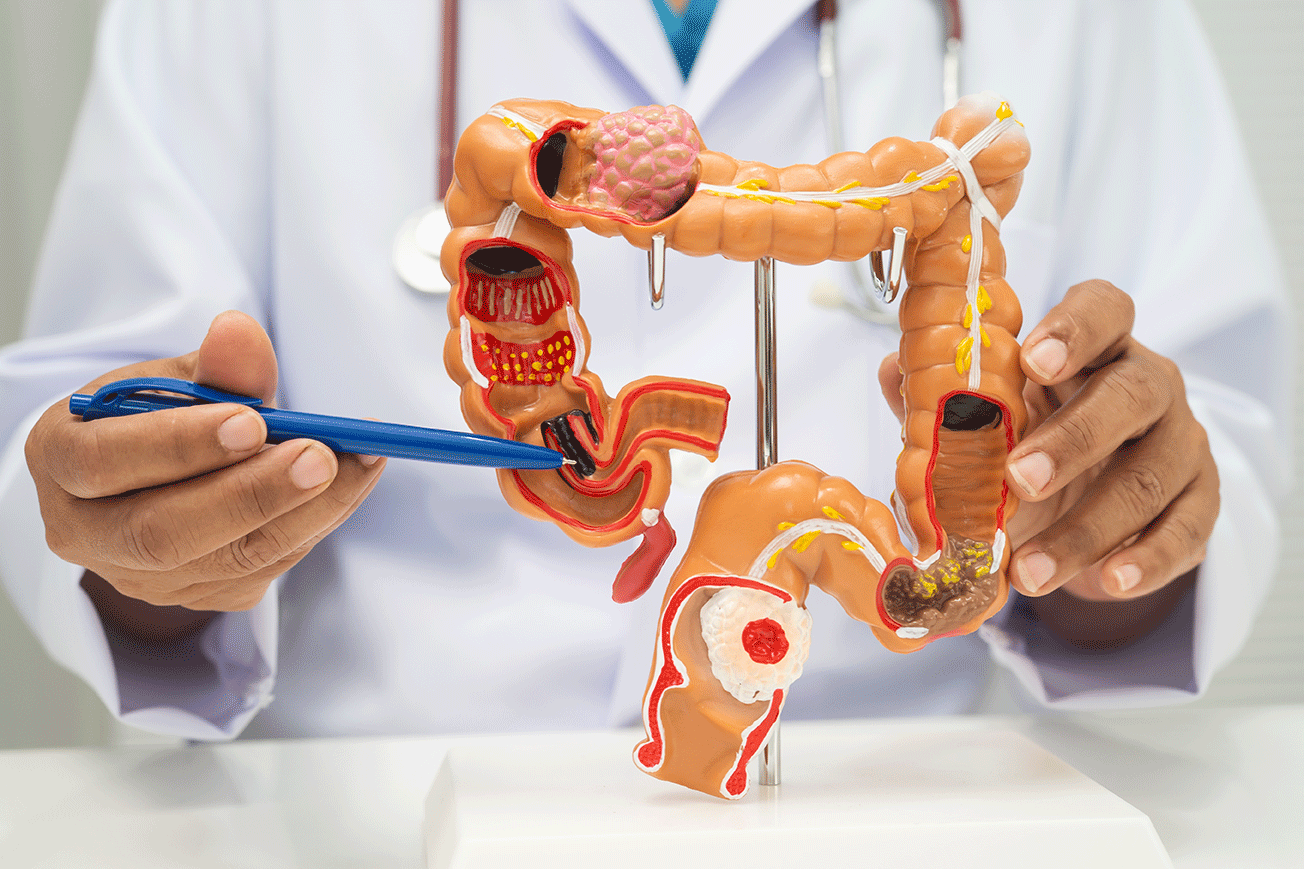 Doctor holding a human colon model while explaining colorectal cancer and digestive health conditions during a medical consultation.